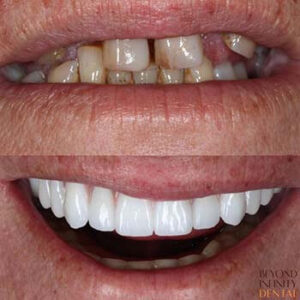 What Do Teeth Look Like Under Veneers? Their Types And Benefits